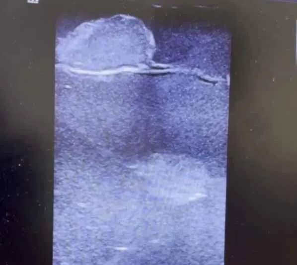 Breast Model (B-Ultrasound Guided Puncture Model) factory